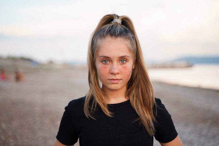 Gesicht einer jungen Frau mit Sonnenbrand