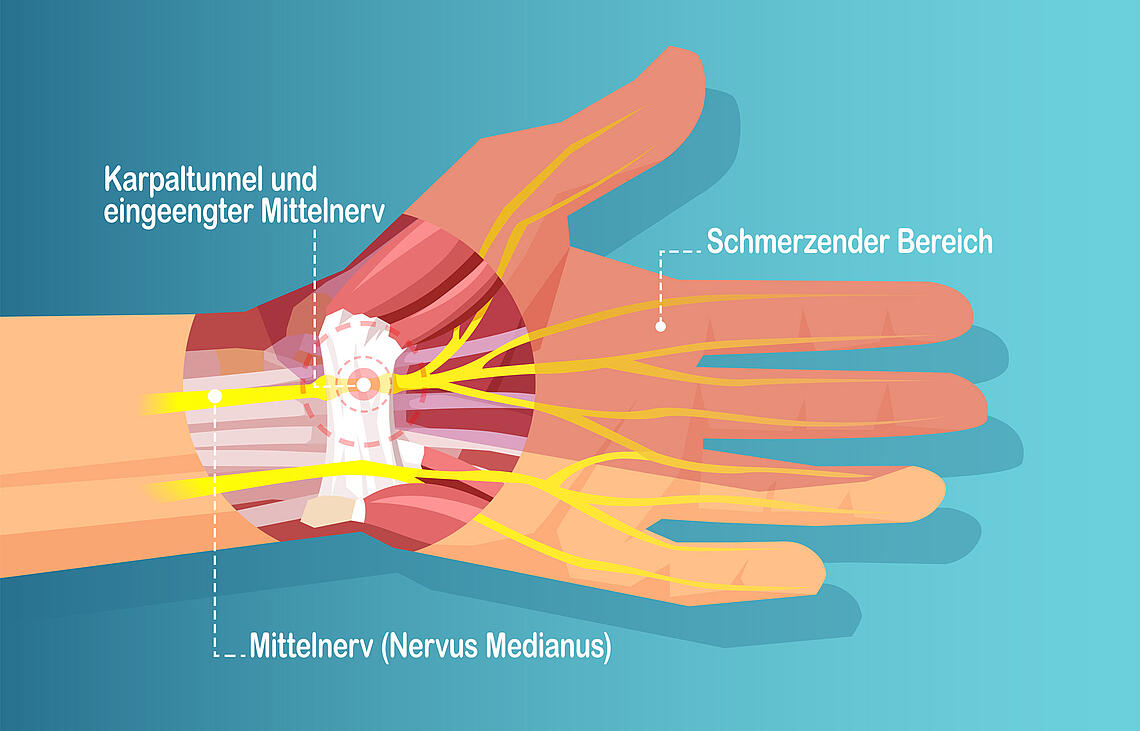 Karpaltunnelsyndrom Symptome Ursachen Und Behandlung Vigo