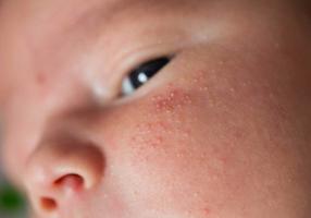 Hitzepickel im Gesicht eines Babys