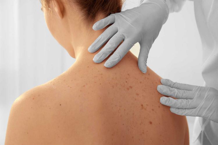 Hautärztin untersucht den Rücken einer Patientin zur Früherkennung von Hautkrebs