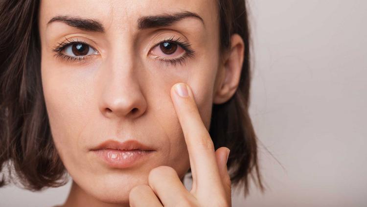 Frau mit mit Bindehautentzündung zieht mit dem Finger ihr Augenlid nach unten