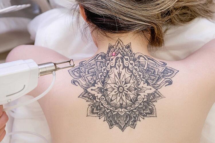 Frau lässt Tattoo im Nacken mit Laser entfernen